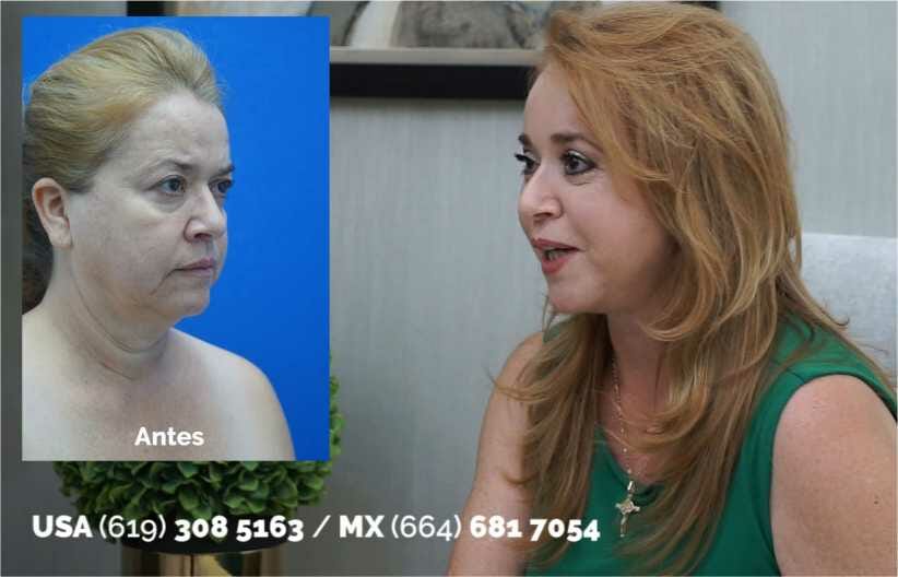 Full Facelift