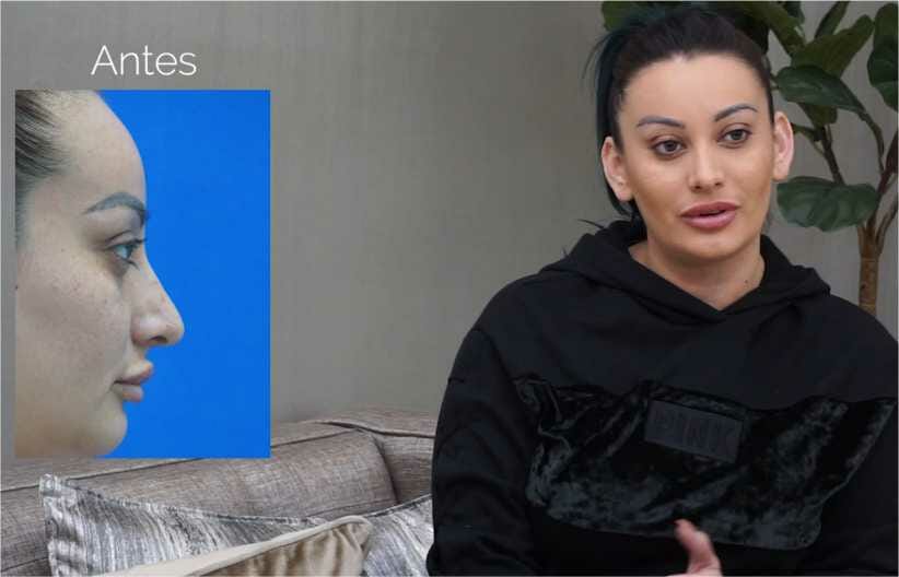 Nose Surgery | Rhinoplasty