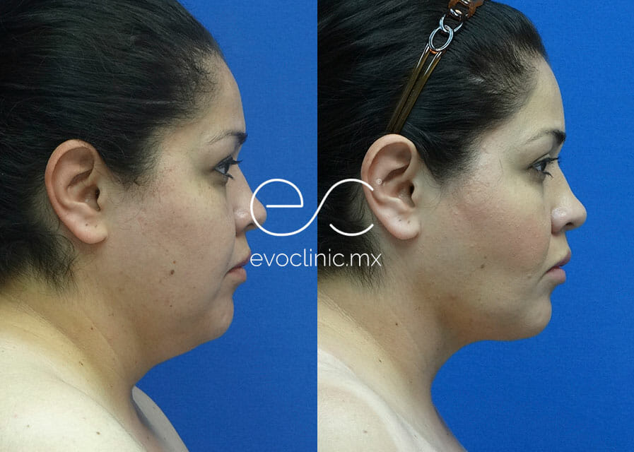 Máscara facial cerrada, cuello medio, post lipoplastía de mentón