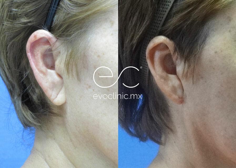 How is Earlobe Repair Performed? - VIDA Wellness and Beauty