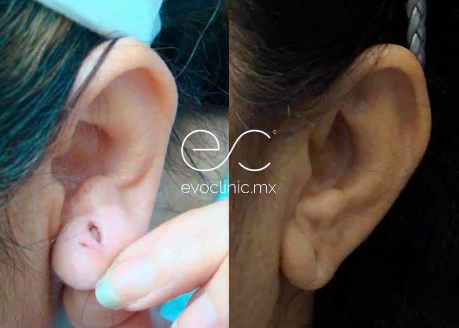 Earlobe Repair Surgery, Chicago, IL