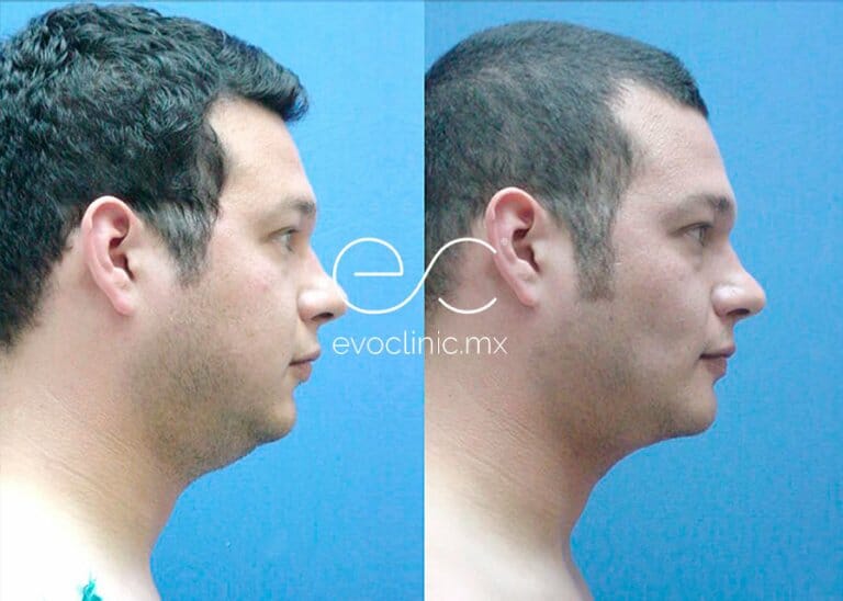Liposucción Facial: La Guía Definitiva para un Rostro Más Definido y Joven