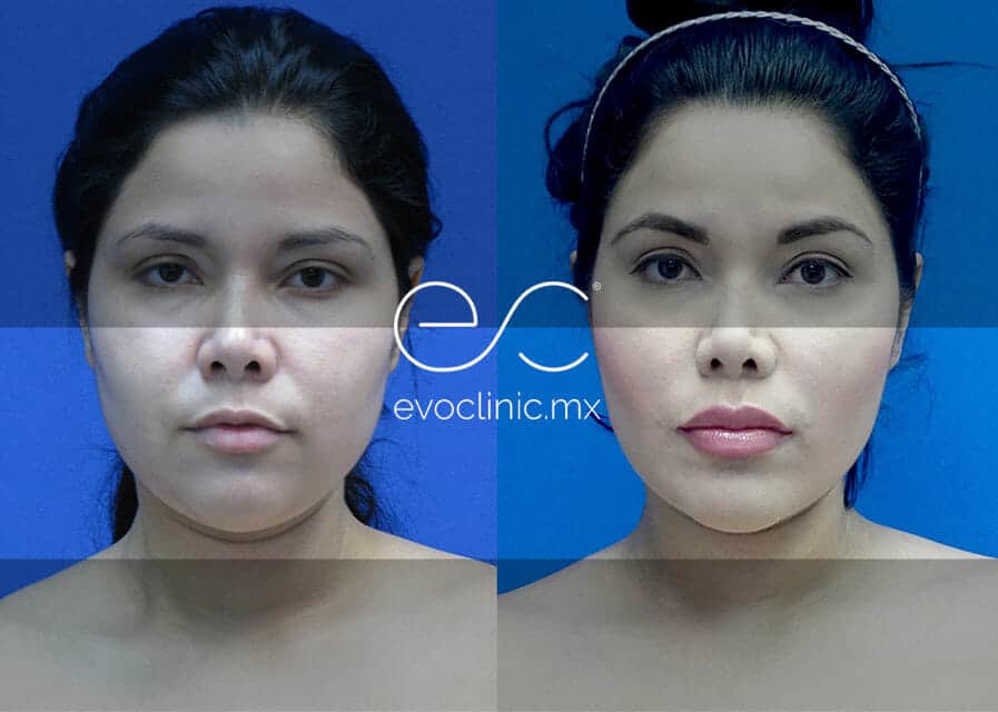 Lip Augmentation | Before and After | evoclinic