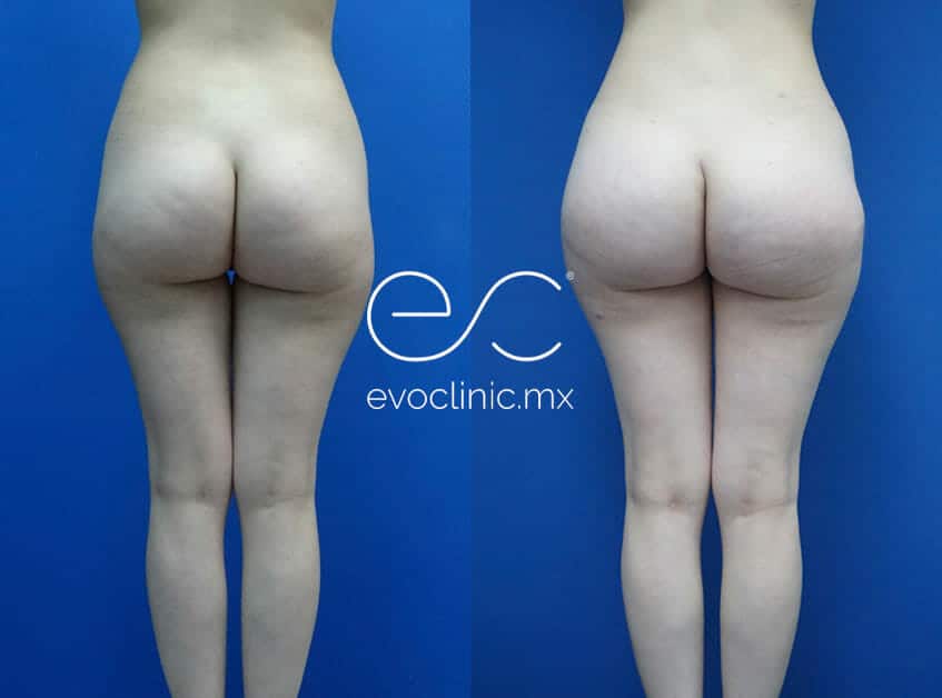 Buttocks Augmentation with Implants, Body Surgery