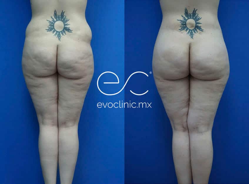 https://www.evoclinic.mx/wp-content/uploads/2017/06/Buttocks_Lift_01.jpg