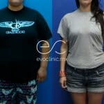 A mega lipo photo - befor and after