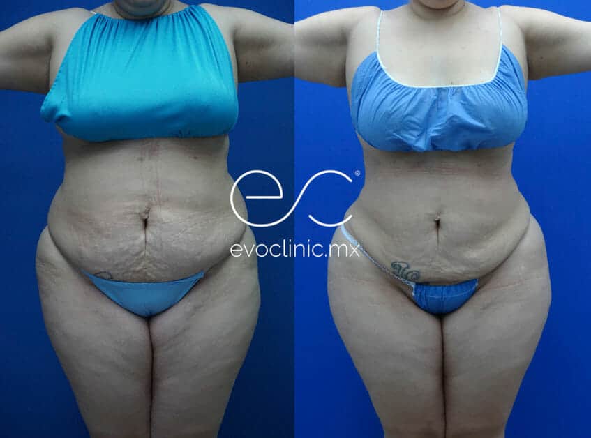 women with front mega liposuction
