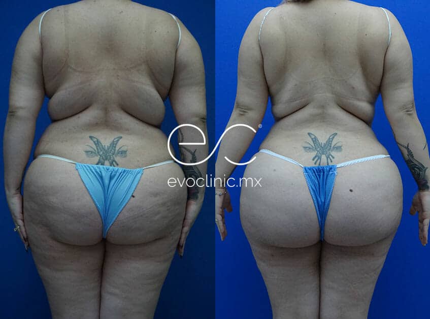 women with back mega liposuction