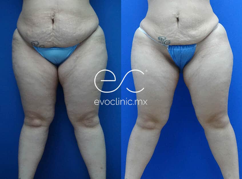 women with liposuction in legs