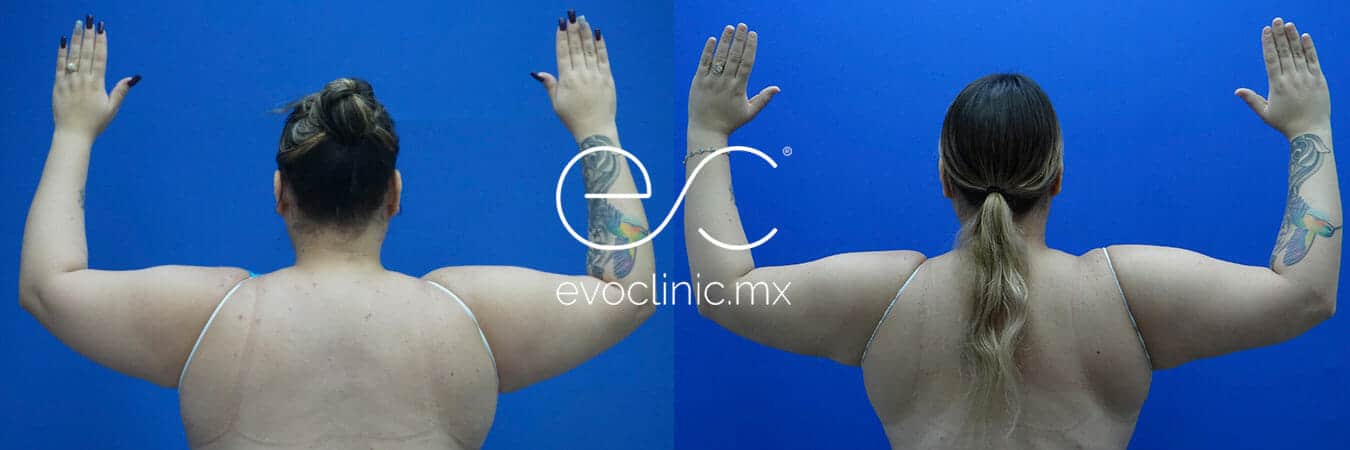 women with mega liposuction in arms