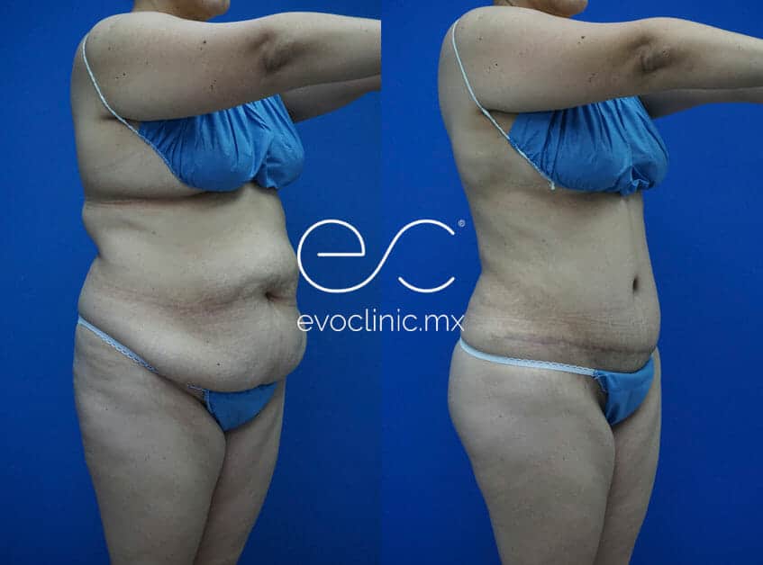 Are You a Candidate for Tummy Tuck? - Salas Plastic Surgery