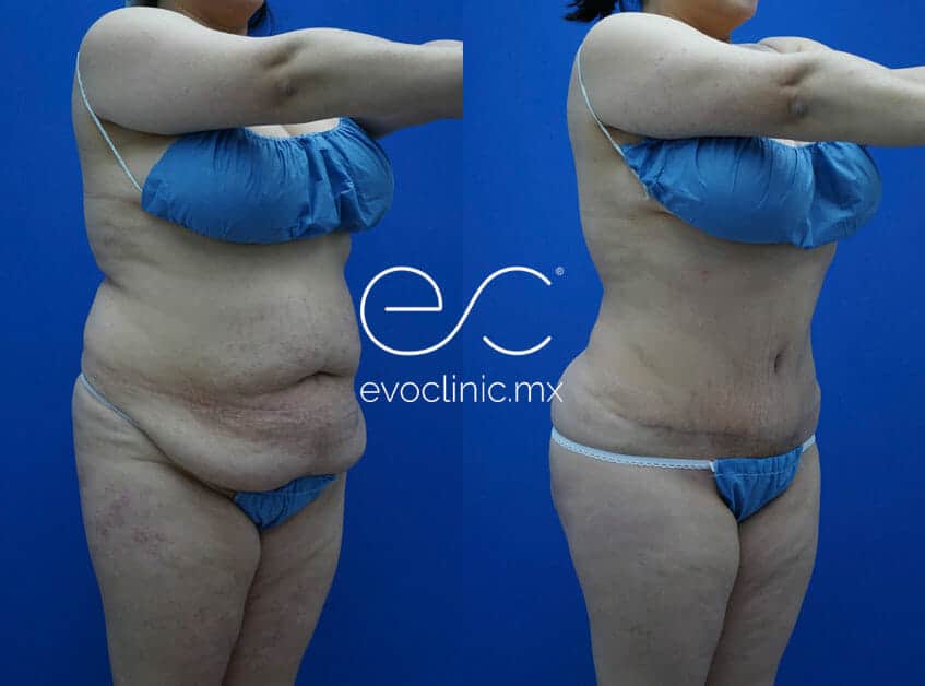 Tummy Tuck in Tijuana, Body Surgery