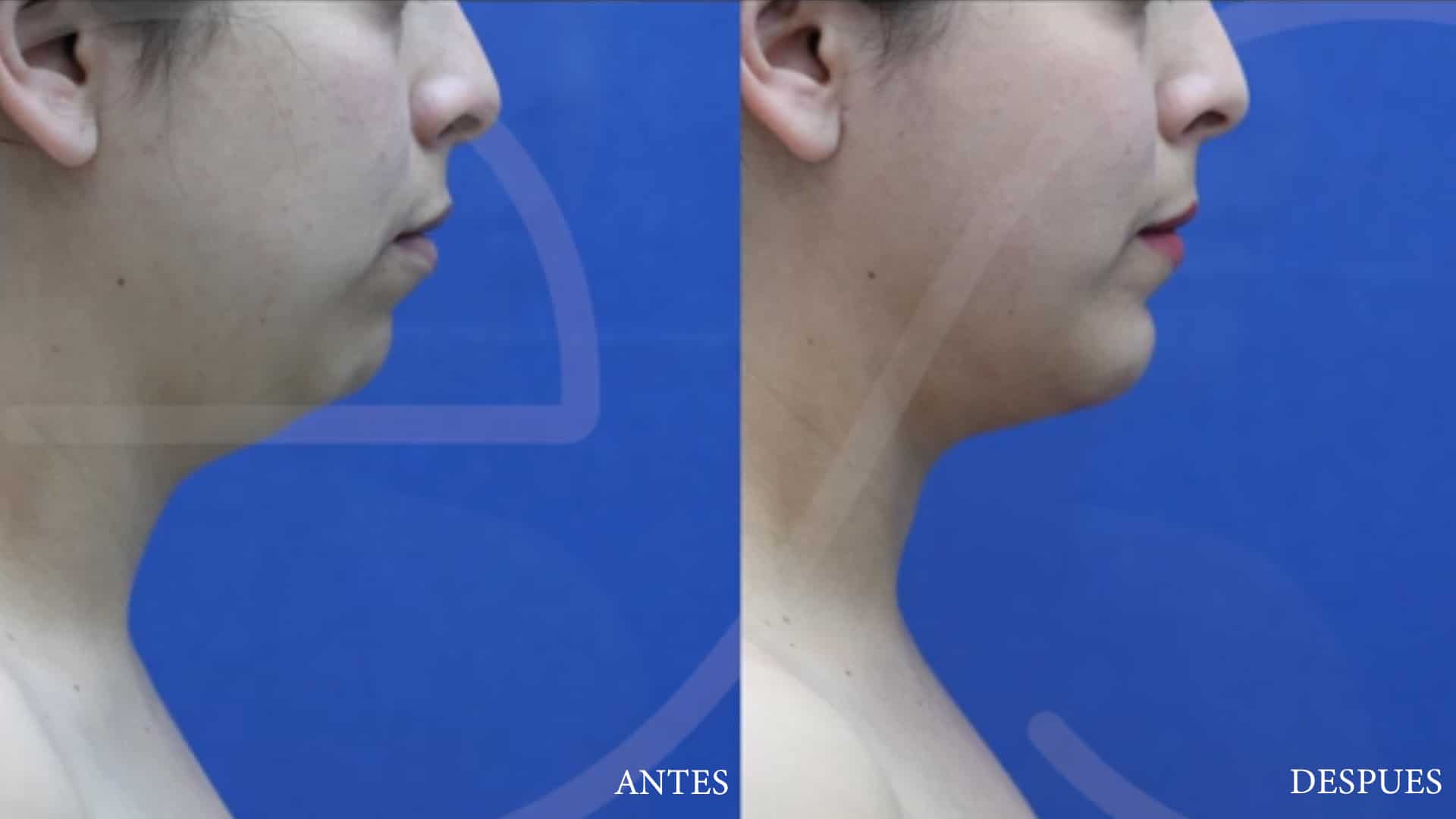 Liposucción de Mejillas y Cuello + Aumento de Mentón