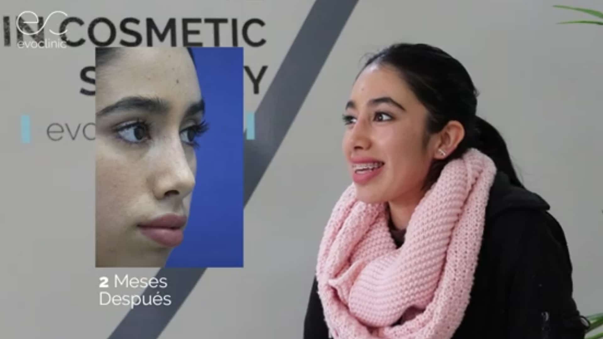 Rinoplastia - Nose Job