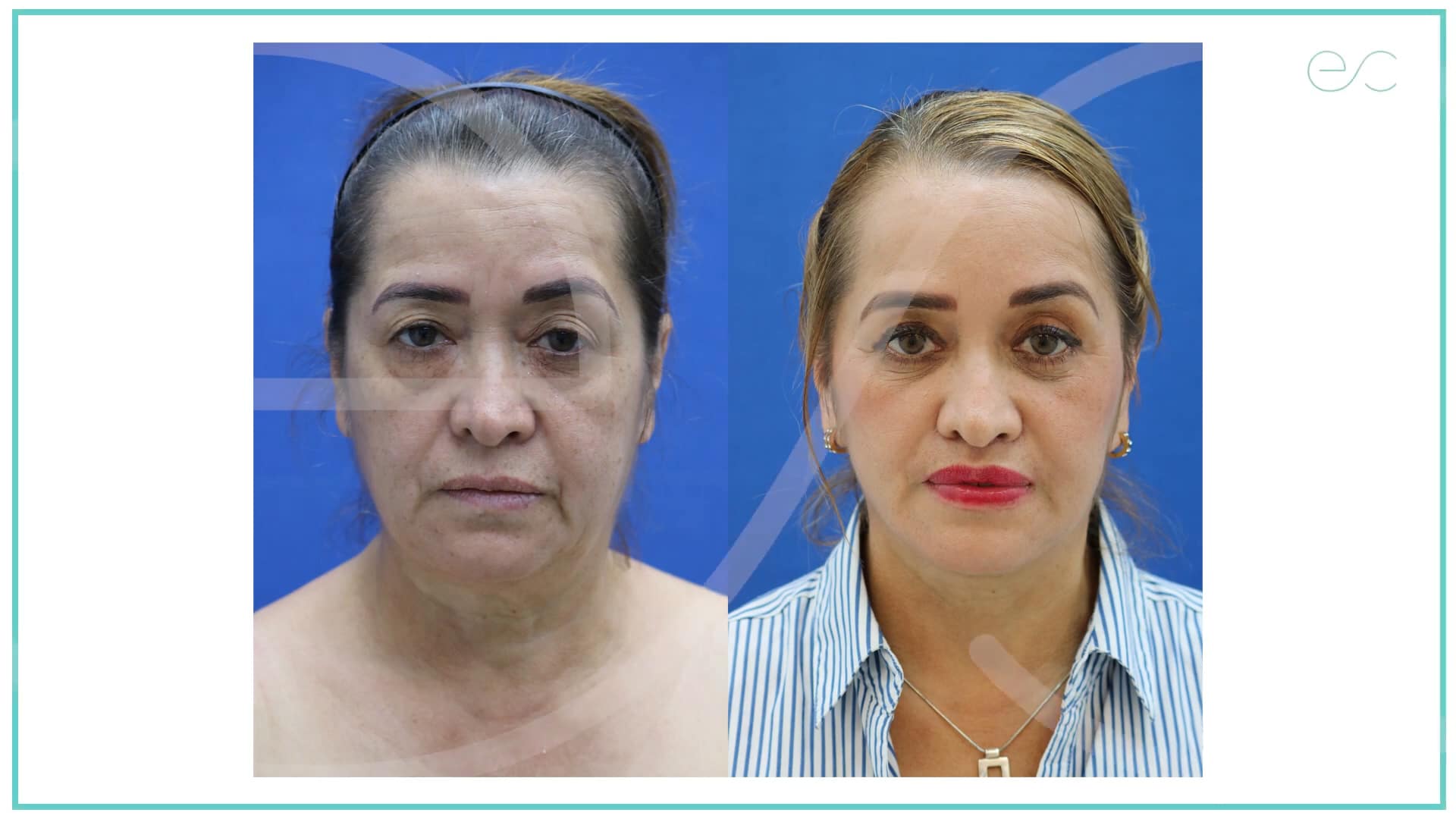 Rejuvenecimiento Facial + Levantamiento de Labio