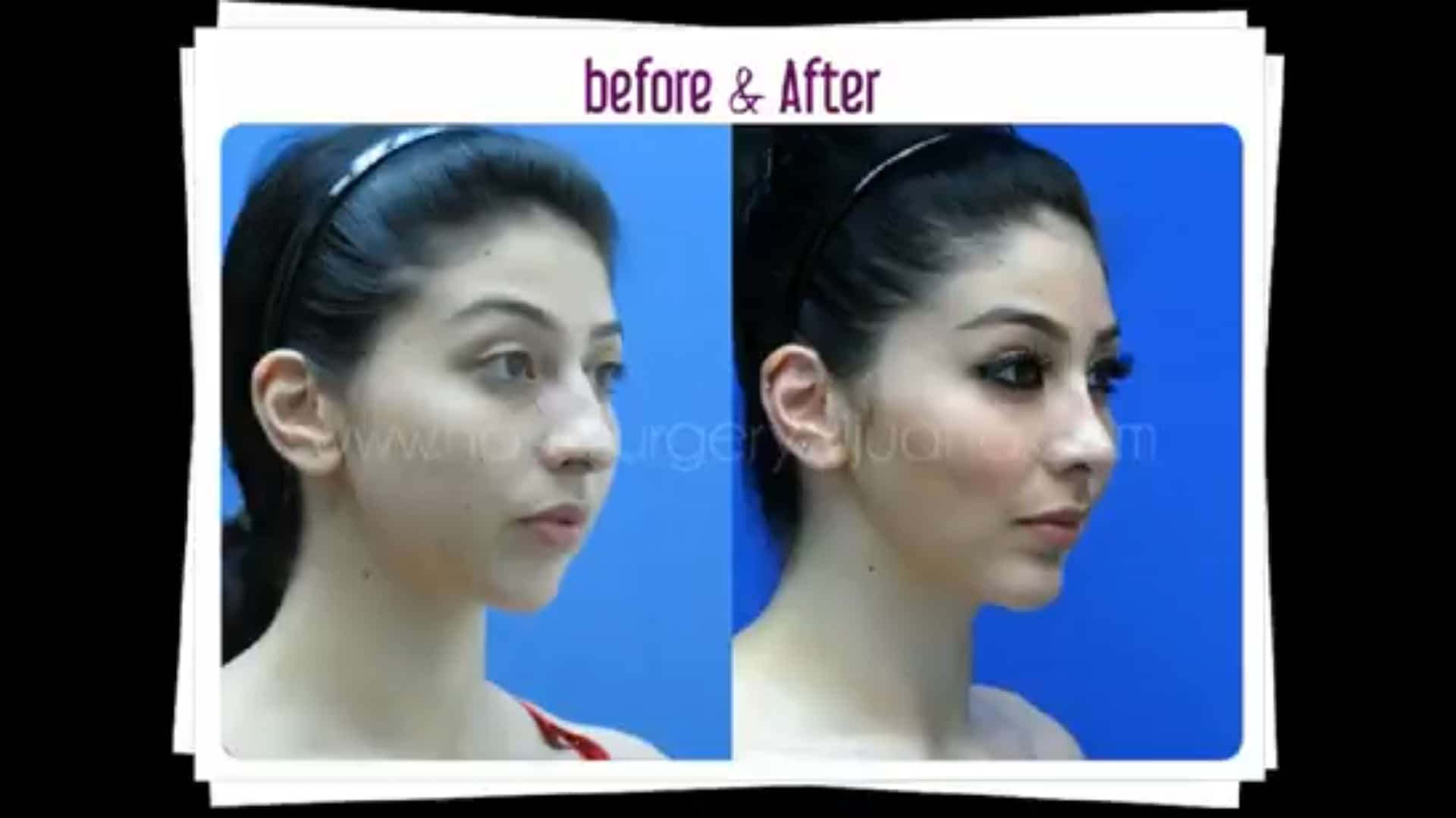 Nose Job