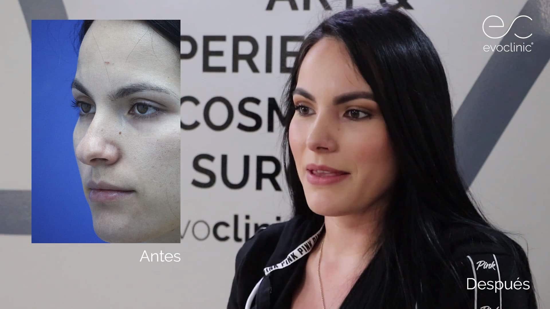 Rinoplastia - Cirugía de Nariz
