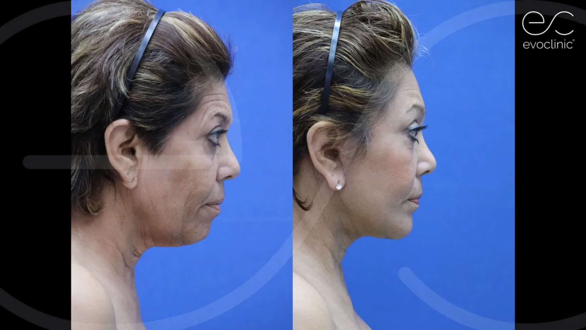 Mini Facelift