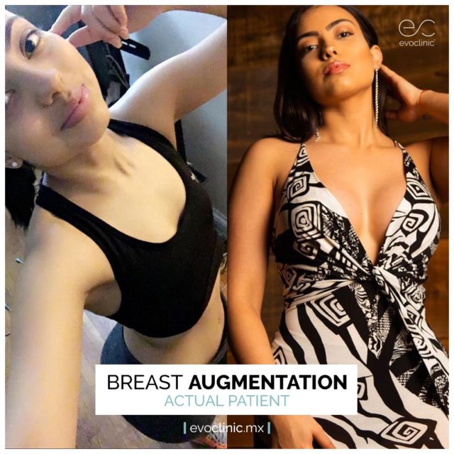 breast-augmentation-before-and-after