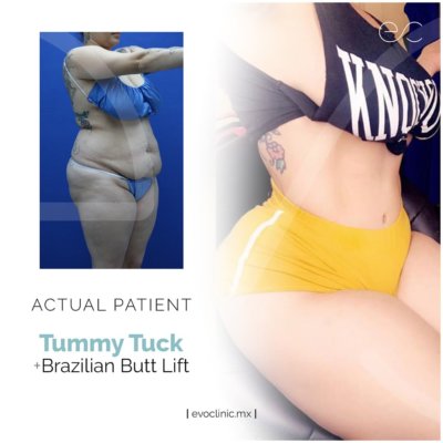 11- Tummy tuck_bbl_Hasly Chasity 2
