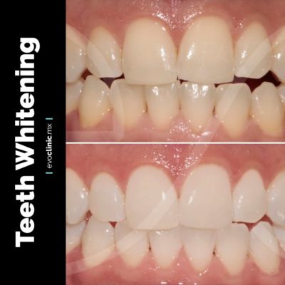 EXTRA- teeth whitening