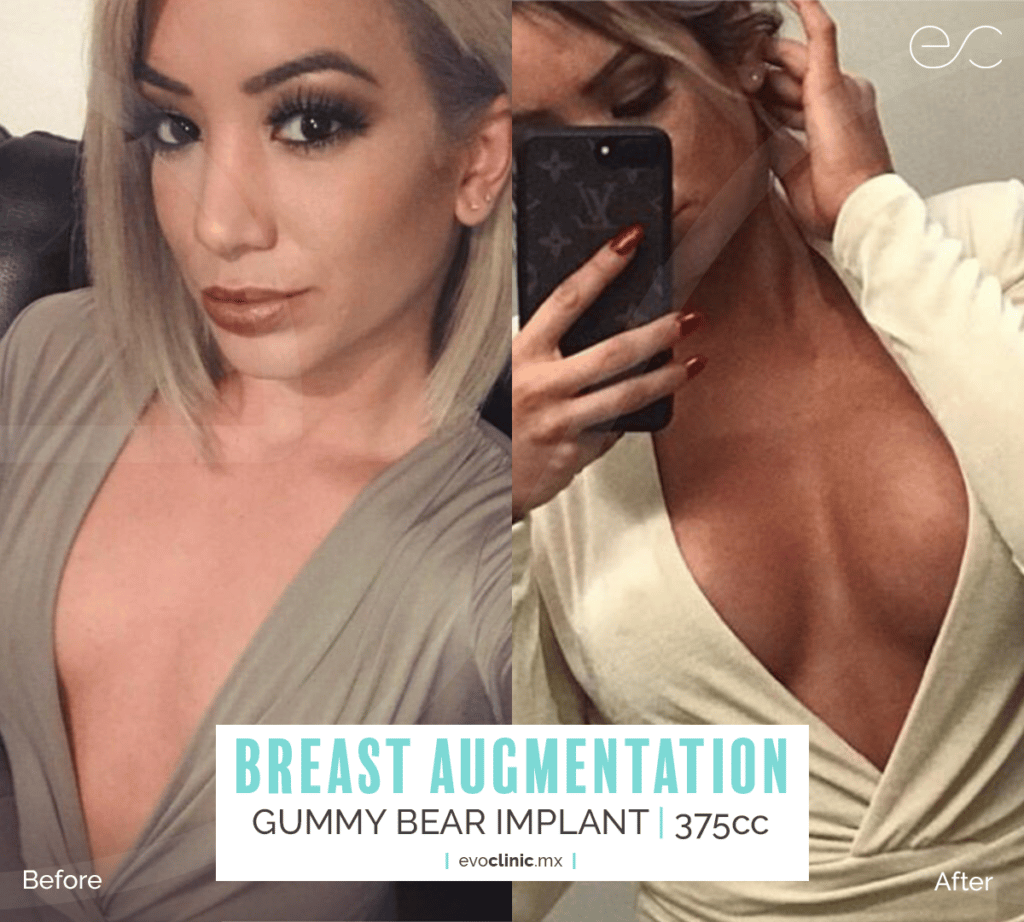 Breast Augmentation in Evoclinic