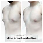 Male breast reduction before and after