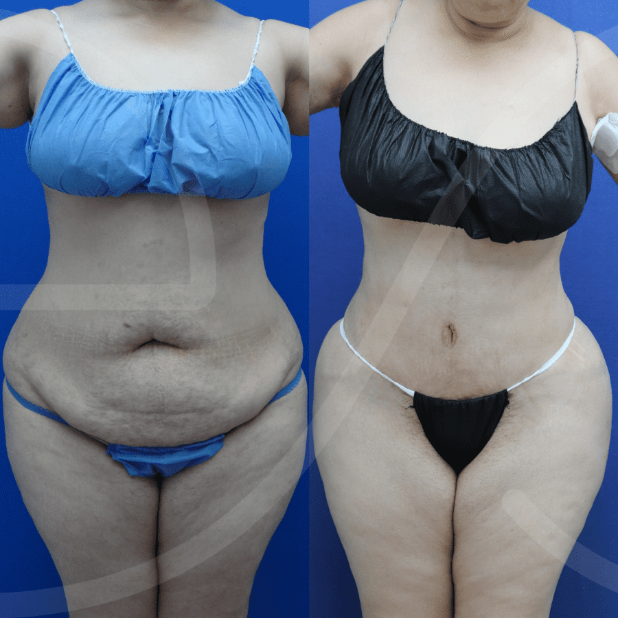 https://www.evoclinic.mx/wp-content/uploads/2023/10/lipo-360-Maldonado-Patricia.png