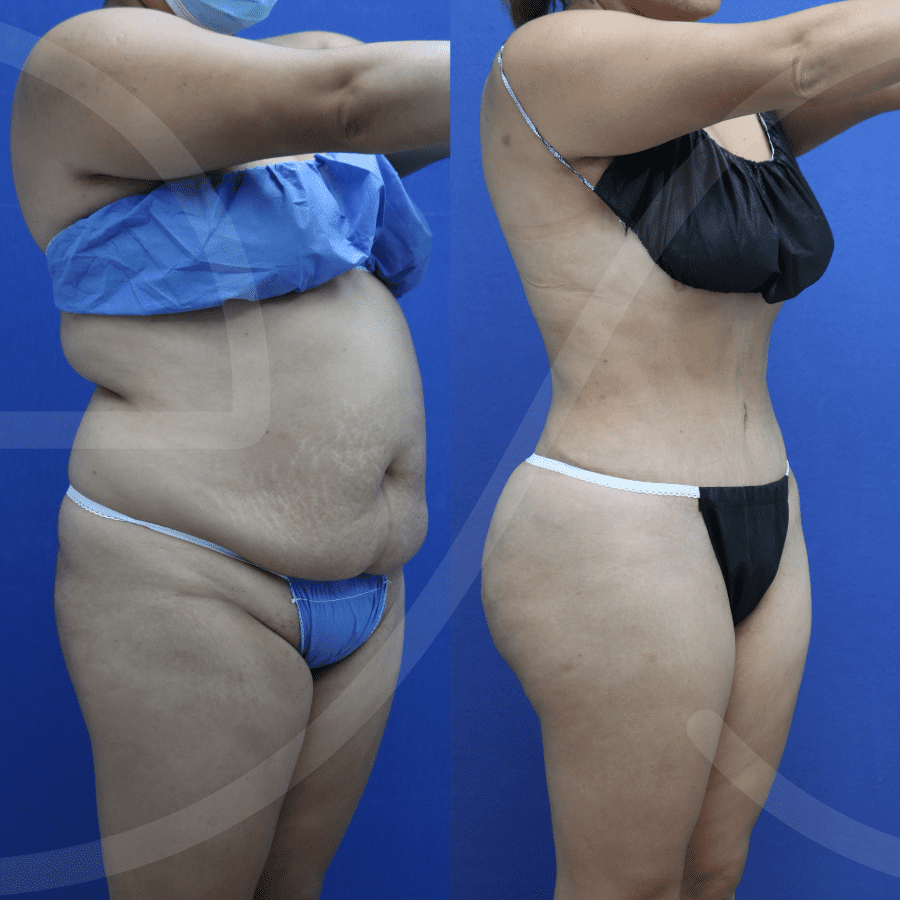 https://www.evoclinic.mx/wp-content/uploads/2023/10/lipo360-Martinez-Sanches.png