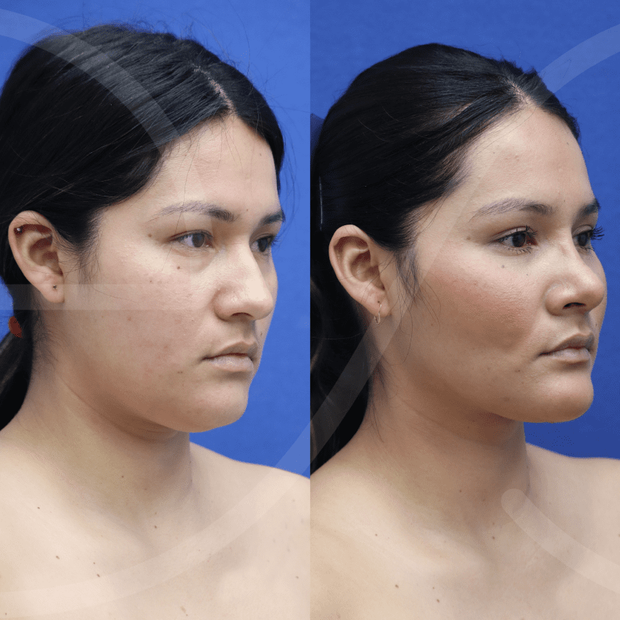 Jawline Surgery Results