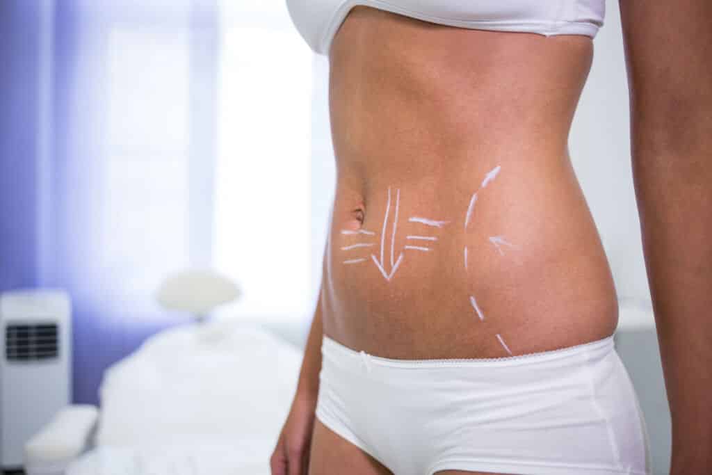 Female body with drawing arrows abdomen liposuction cellulite removal