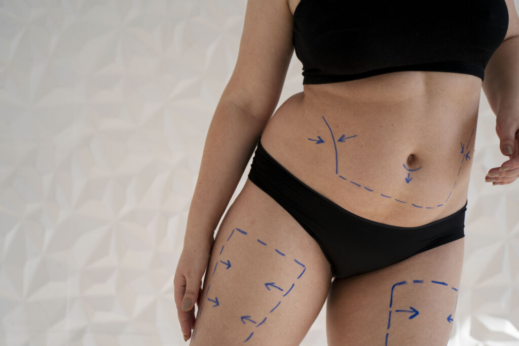 womans body with marker traces front view