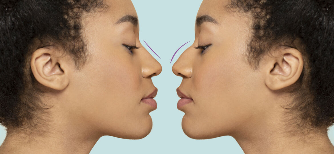 woman-getting-ready-nose-job-surgery