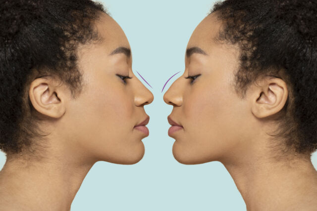 woman-getting-ready-nose-job-surgery