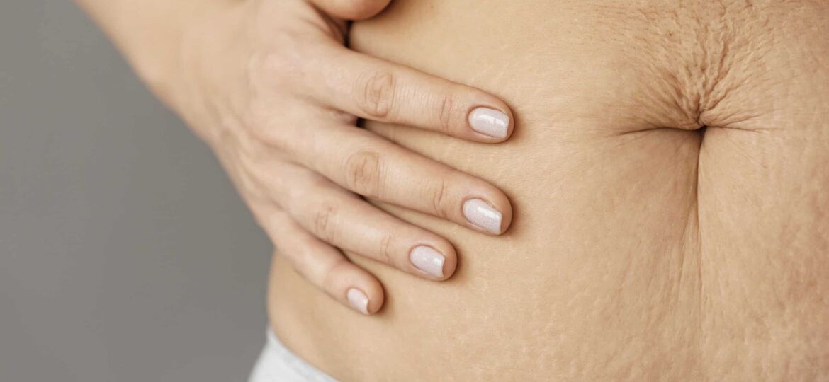 tummytuck}