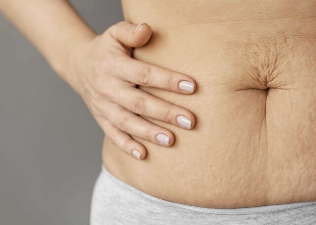 tummytuck}
