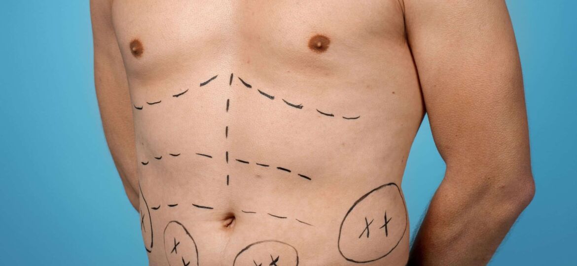 tummytuck}_7