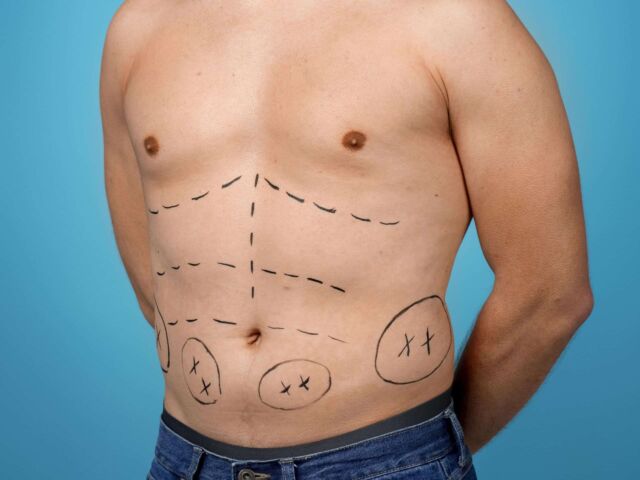 tummytuck}_7