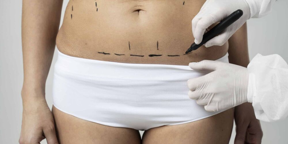 mujer-de-vista-frontal-con-rastros-de-marcador-en-la-piel Getting ready for a sking removal surgery