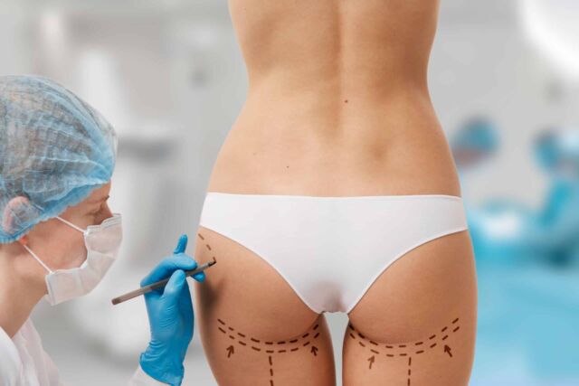Brazilian Butt during consultation